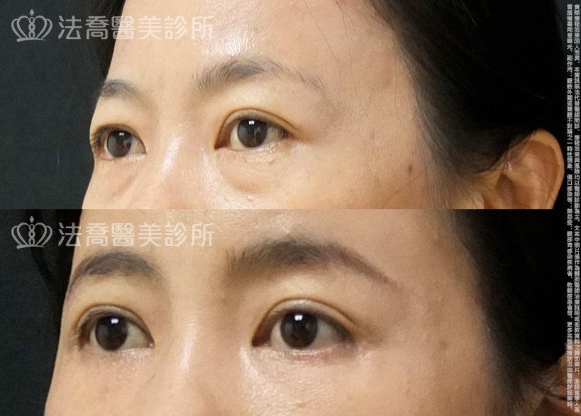 法喬醫美診所,邱浚彥,自體脂肪豐全臉,切眉,眼袋外開