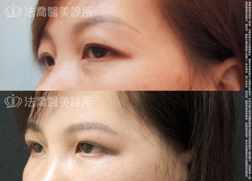 法喬醫美診所,邱浚彥,切眉