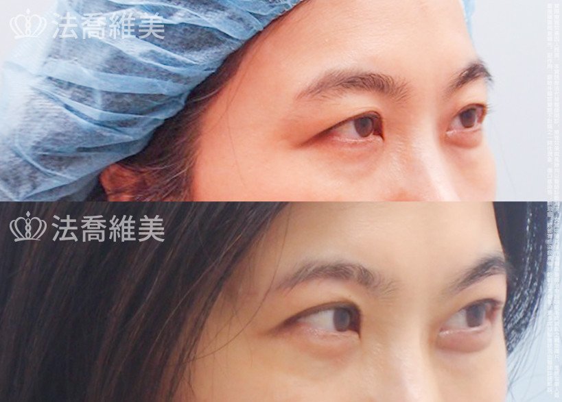 法喬醫美診所,邱浚彥,切眉