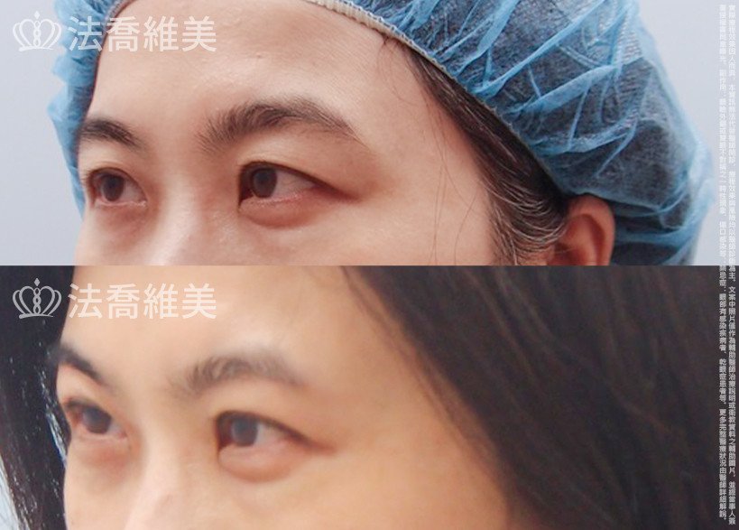 法喬醫美診所,邱浚彥,切眉