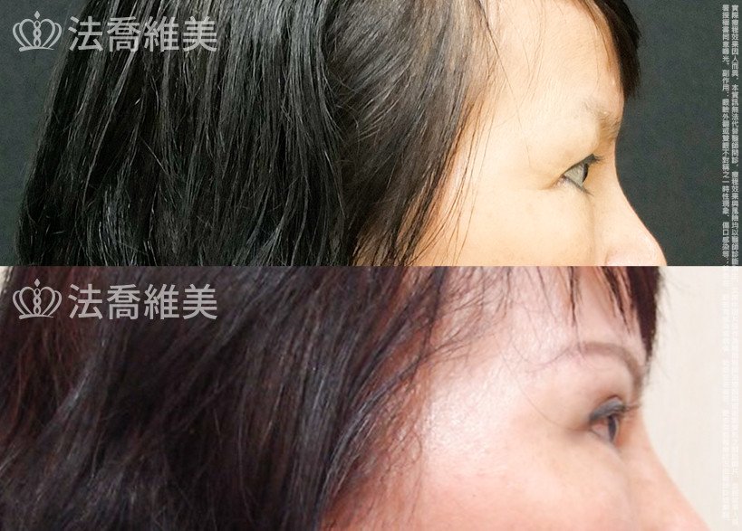 法喬醫美診所,邱浚彥,切眉