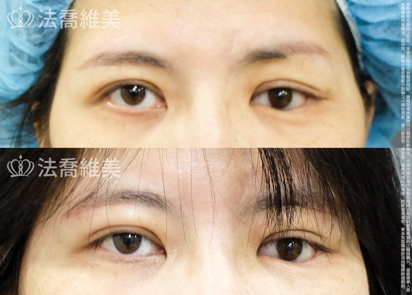 法喬醫美診所,邱浚彥,切眉