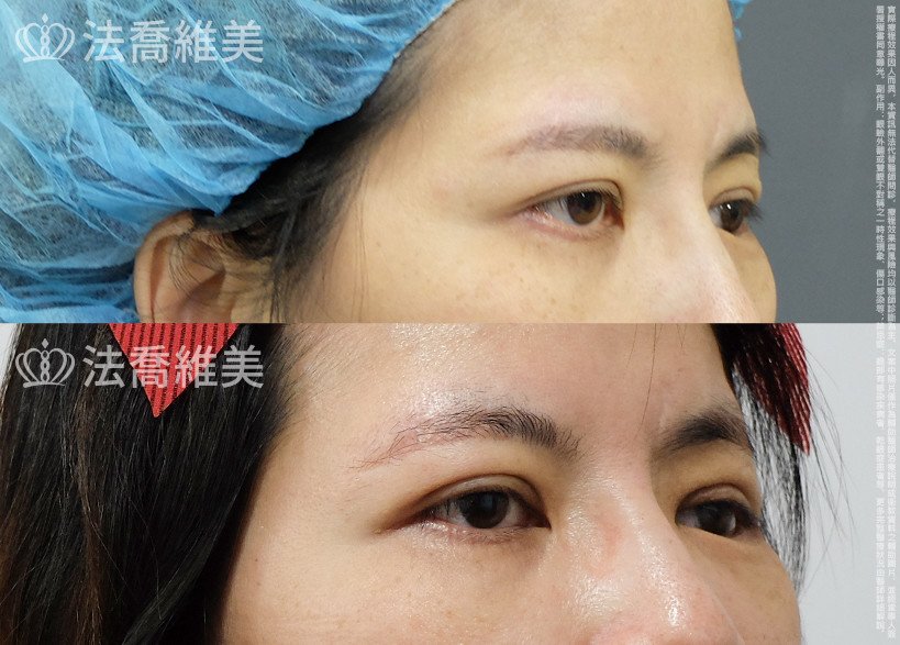 法喬醫美診所,邱浚彥,切眉