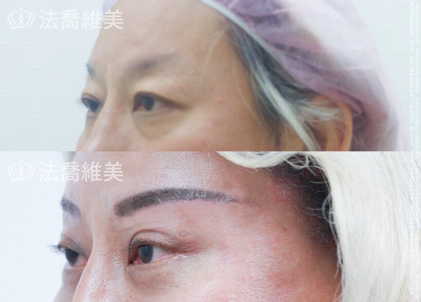 法喬醫美診所 邱浚彥醫師,切眉