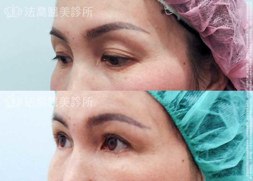 法喬醫美診所,邱浚彥,自體脂肪豐臉,割雙眼皮,眼袋外開