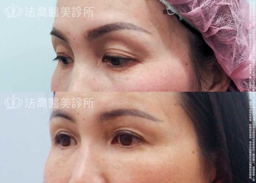 法喬醫美診所,邱浚彥,自體脂肪豐臉,割雙眼皮,眼袋外開