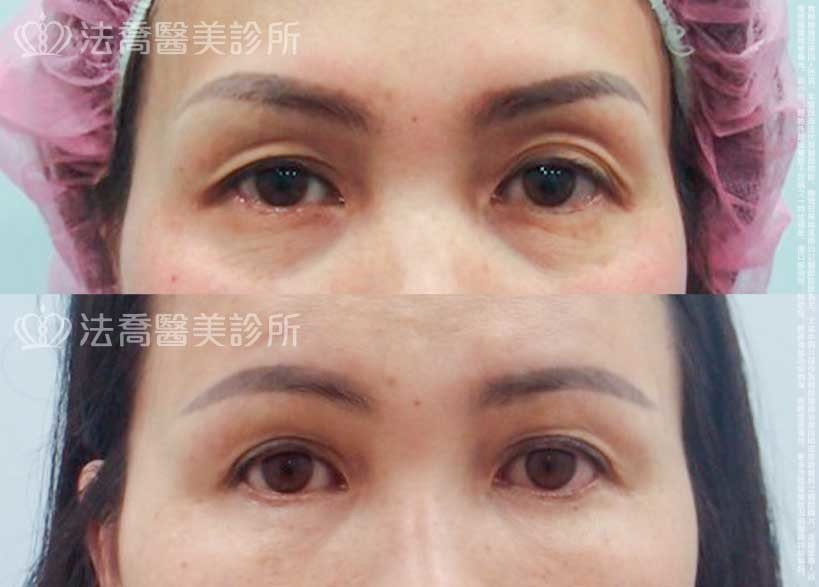 法喬醫美診所,邱浚彥,自體脂肪豐臉,割雙眼皮,眼袋外開