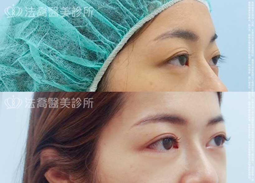 法喬醫美診所,邱浚彥,割雙眼皮