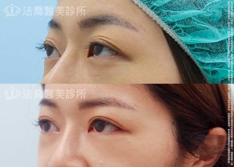 法喬醫美診所,邱浚彥,自體脂肪豐臉,割雙眼皮,眼袋外開