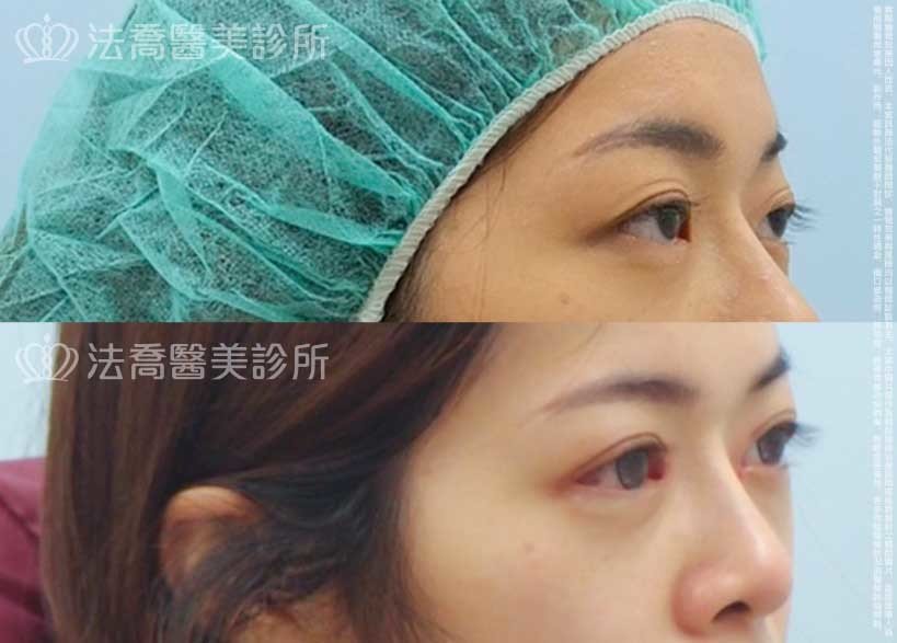法喬醫美診所,邱浚彥,割雙眼皮