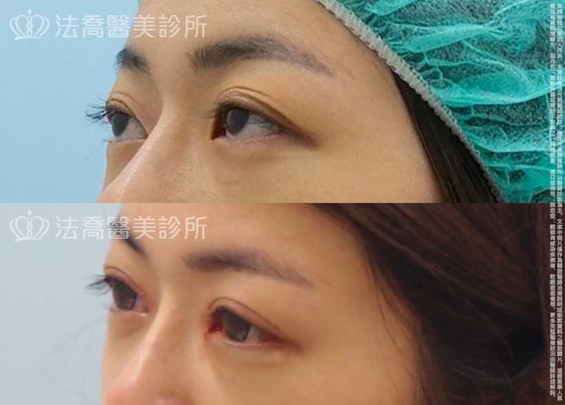 法喬醫美診所,邱浚彥,割雙眼皮