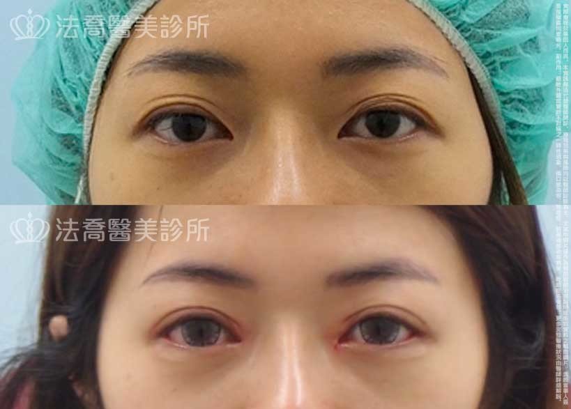 法喬醫美診所,邱浚彥,割雙眼皮