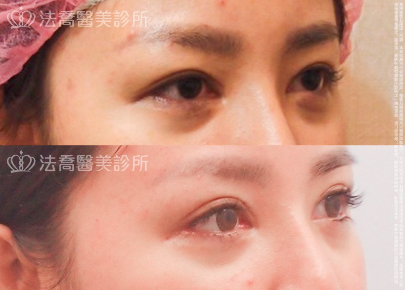 法喬醫美診所,邱浚彥,割雙眼皮,開眼頭,開眼尾