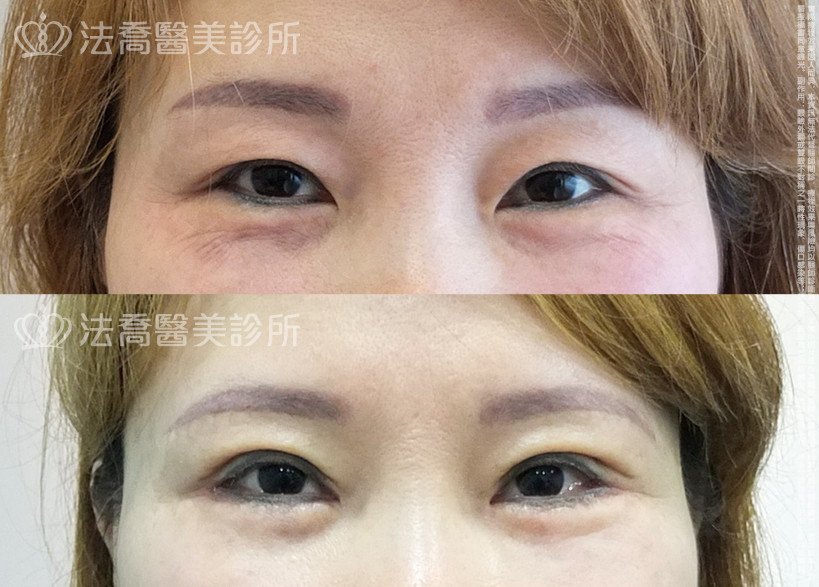 法喬醫美診所,邱浚彥,切眉