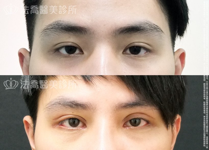 法喬醫美診所,邱浚彥,割雙眼皮,開眼頭,開眼尾