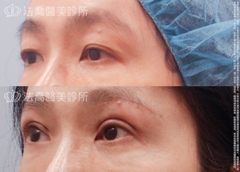 法喬醫美診所,邱浚彥,割雙眼皮,開眼頭,開眼尾