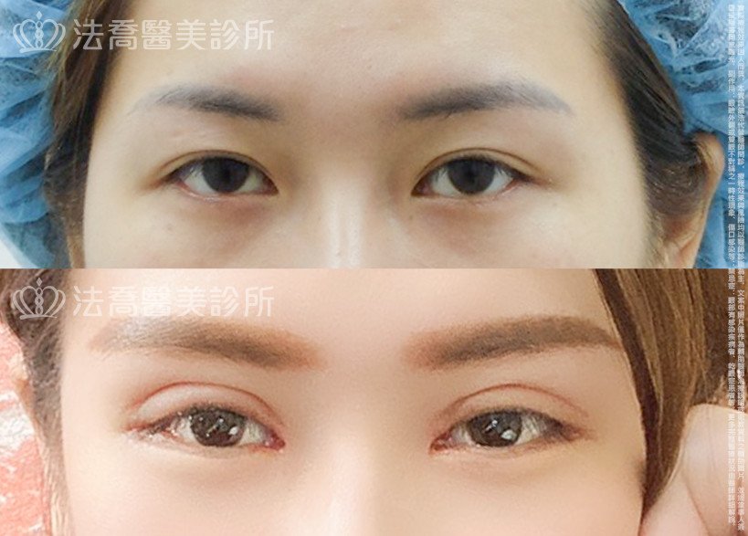 法喬醫美診所,邱浚彥,割雙眼皮