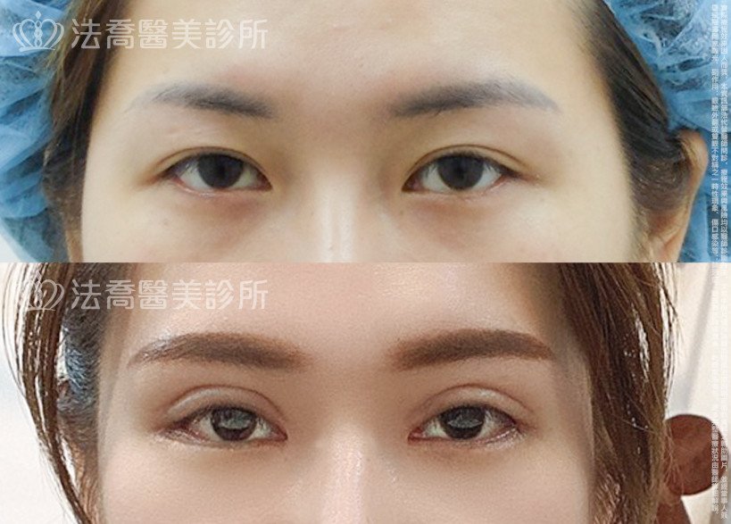 法喬醫美診所,邱浚彥,割雙眼皮