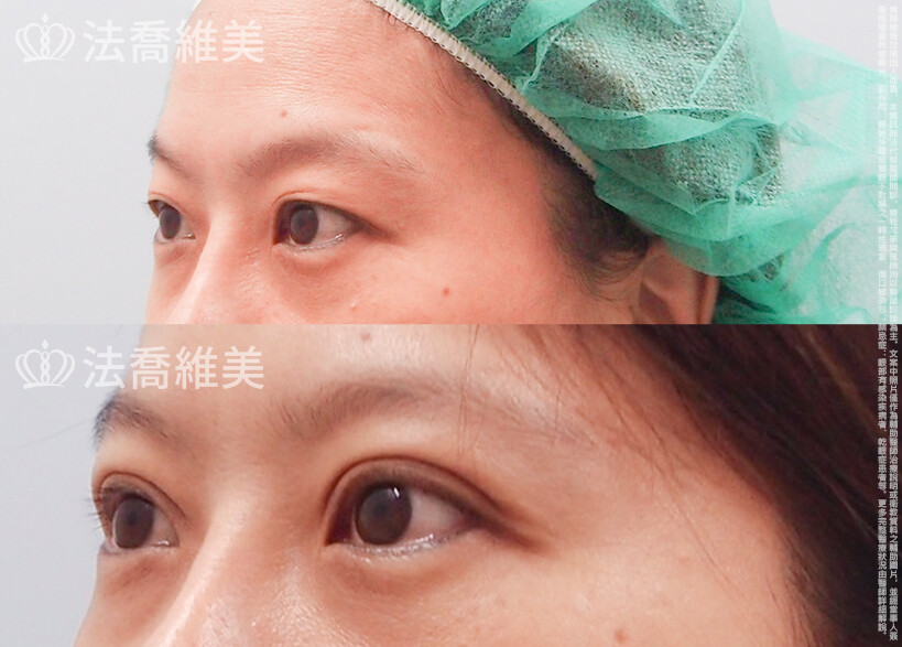 法喬醫美診所,邱浚彥,割雙眼皮