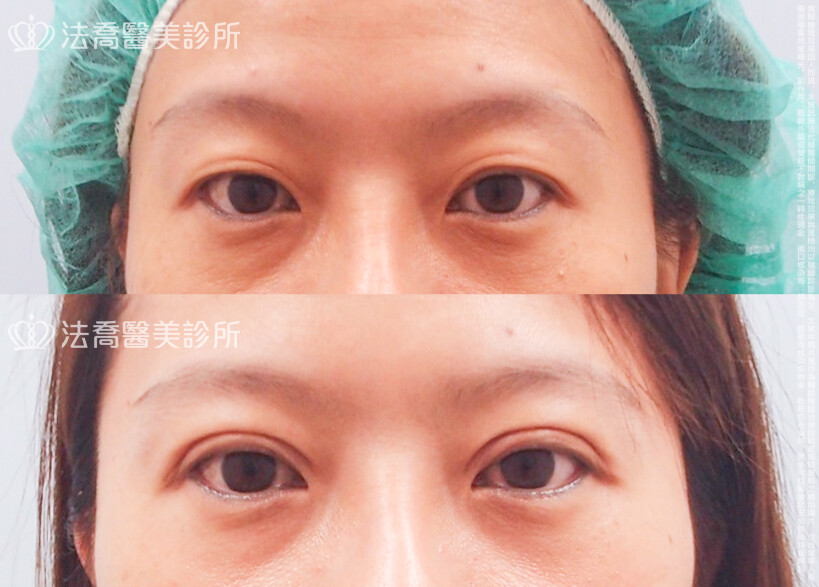 法喬醫美診所,邱浚彥,割雙眼皮
