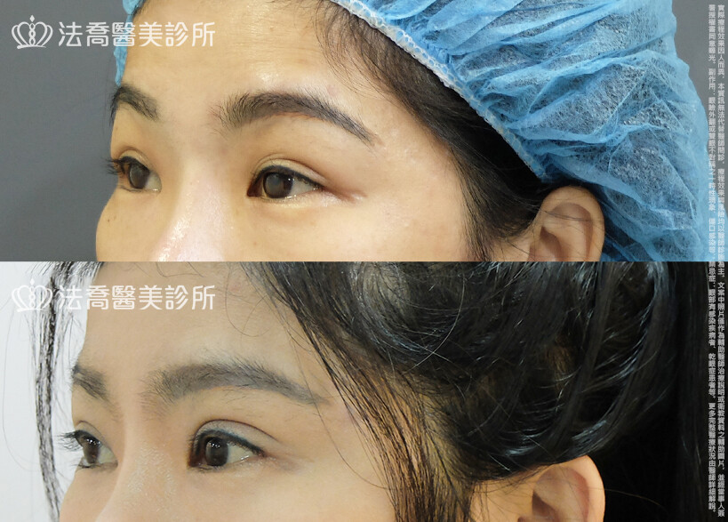 法喬醫美診所,邱浚彥,割雙眼皮,眼瞼肌提拉術,開眼頭,開眼尾