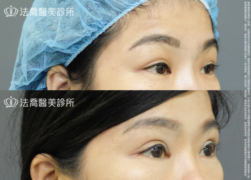 法喬醫美診所,邱浚彥,割雙眼皮,眼瞼肌提拉術,開眼頭,開眼尾