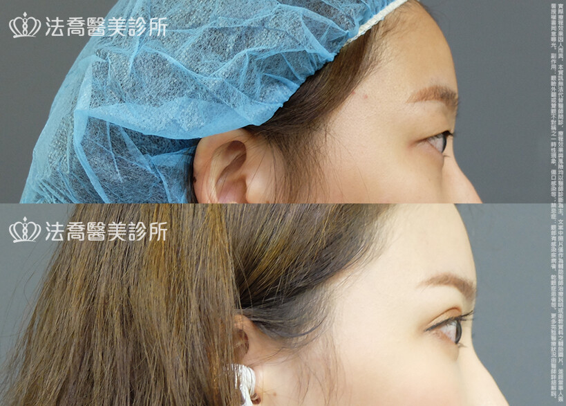 法喬醫美診所,邱浚彥,割雙眼皮,眼瞼肌提拉術