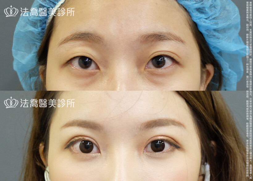 法喬醫美診所,邱浚彥,割雙眼皮,眼瞼肌提拉術