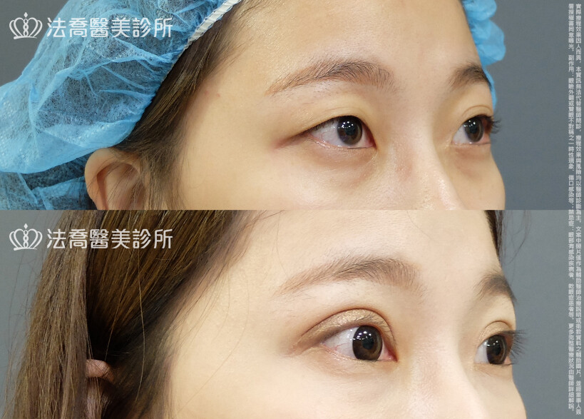 法喬醫美診所,邱浚彥,割雙眼皮,眼瞼肌提拉術