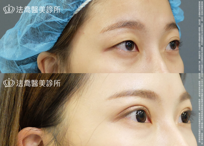 法喬醫美診所,邱浚彥,割雙眼皮,眼瞼肌提拉術
