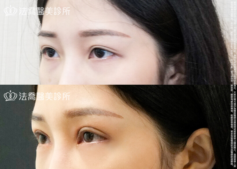 法喬醫美診所,邱浚彥,割雙眼皮,眼瞼肌提拉術,開眼頭,開眼尾