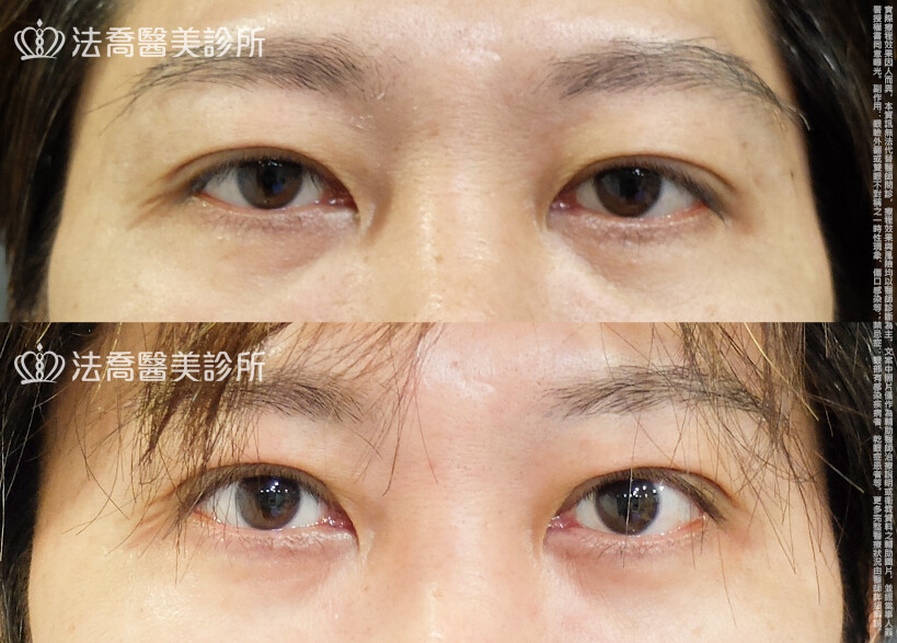 法喬醫美診所,邱浚彥,割雙眼皮,眼瞼肌提拉術