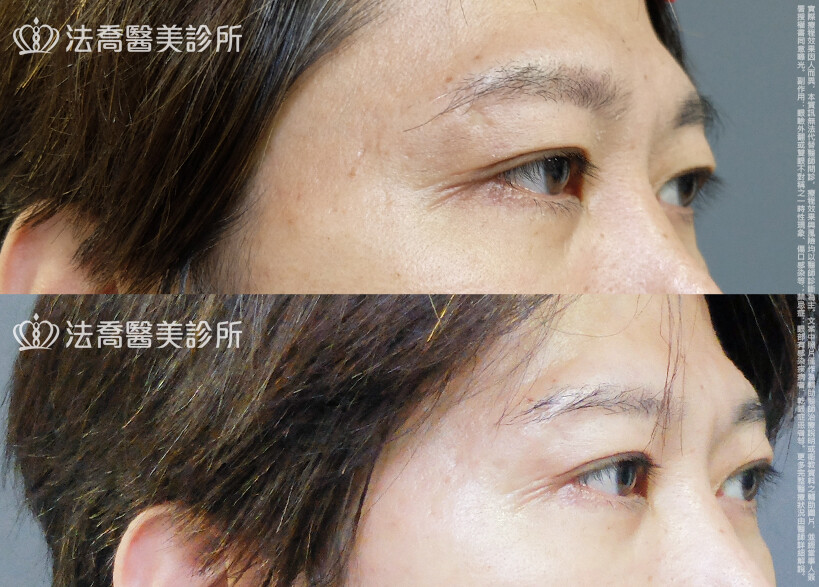 法喬醫美診所,邱浚彥,割雙眼皮,眼瞼肌提拉術
