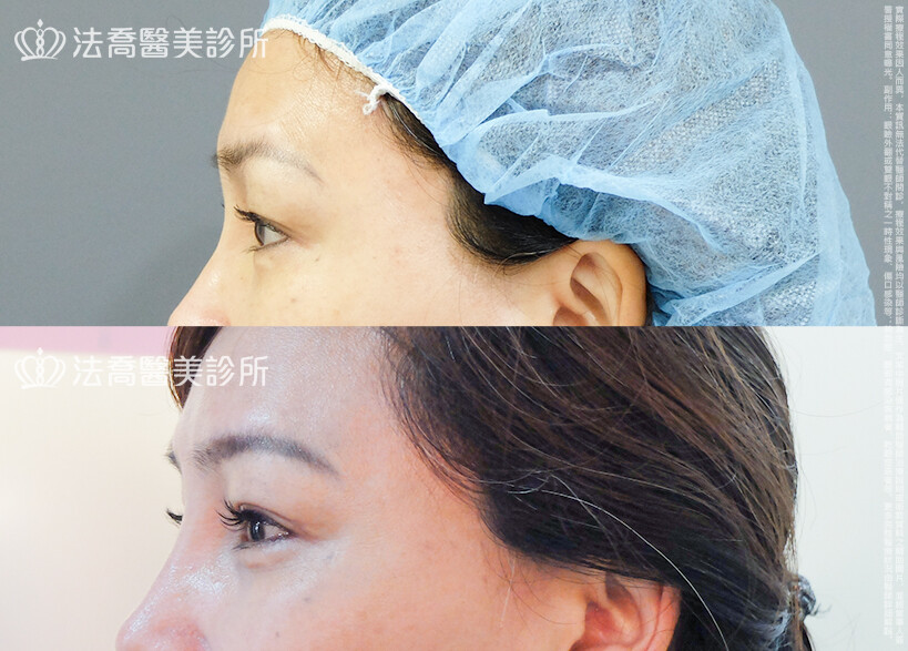 法喬醫美診所,邱浚彥,割雙眼皮,眼瞼肌提拉術
