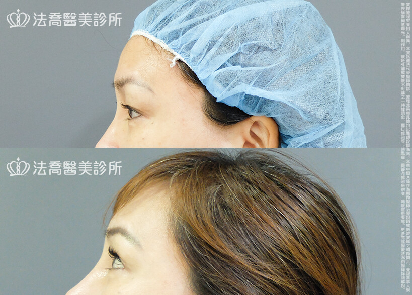 法喬醫美診所,邱浚彥,割雙眼皮,眼瞼肌提拉術