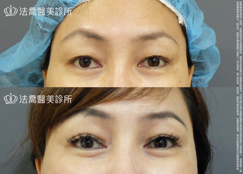 法喬醫美診所,邱浚彥,割雙眼皮,眼瞼肌提拉術