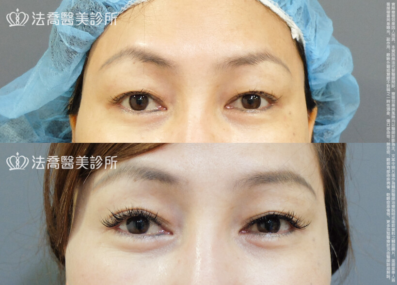法喬醫美診所,邱浚彥,割雙眼皮,眼瞼肌提拉術