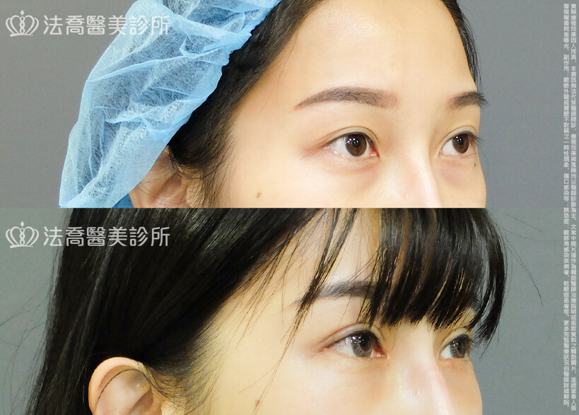 法喬醫美診所 邱浚彥醫師,割雙眼皮,眼瞼肌提拉術,開眼頭,開眼尾