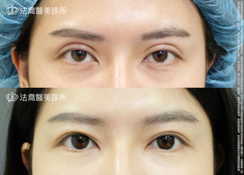 法喬醫美診所,邱浚彥,割雙眼皮,眼瞼肌提拉術