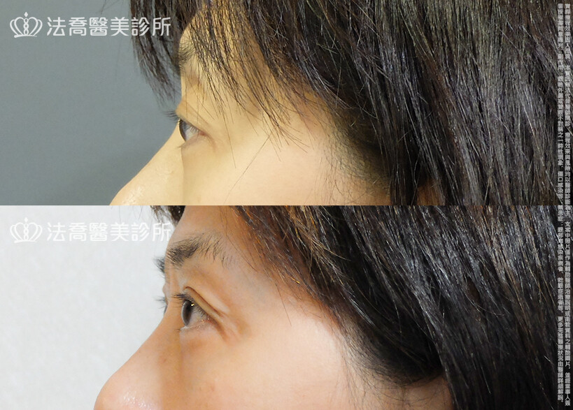 法喬醫美診所,邱浚彥,自體脂肪豐臉,割雙眼皮,眼窩補脂