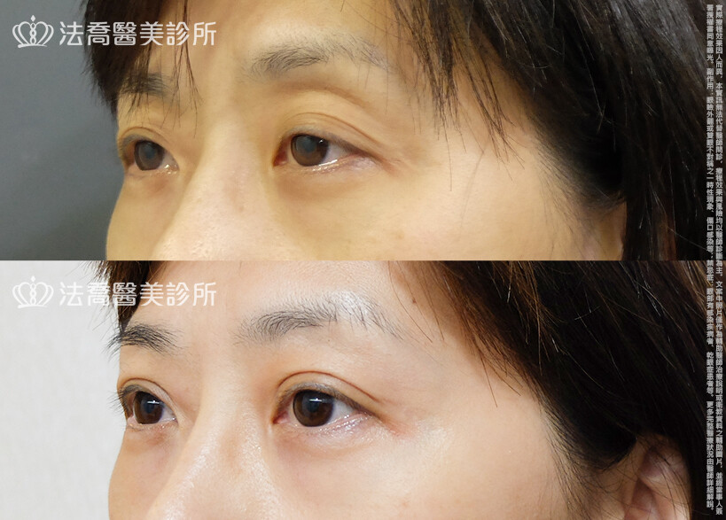 法喬醫美診所,邱浚彥,自體脂肪豐臉,割雙眼皮,眼窩補脂