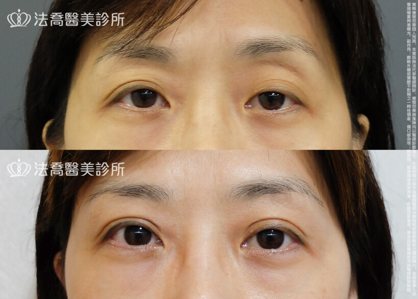 法喬醫美診所,邱浚彥,自體脂肪豐臉,割雙眼皮,眼窩補脂