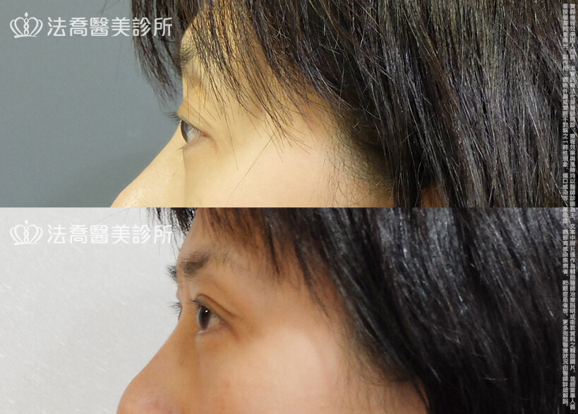 法喬醫美診所,邱浚彥,自體脂肪豐臉,割雙眼皮,眼窩補脂