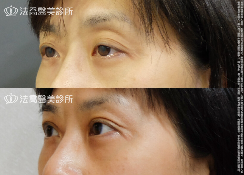 法喬醫美診所,邱浚彥,自體脂肪豐臉,割雙眼皮,眼窩補脂