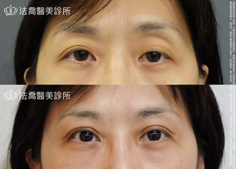 法喬醫美診所,邱浚彥,自體脂肪豐臉,割雙眼皮,眼窩補脂