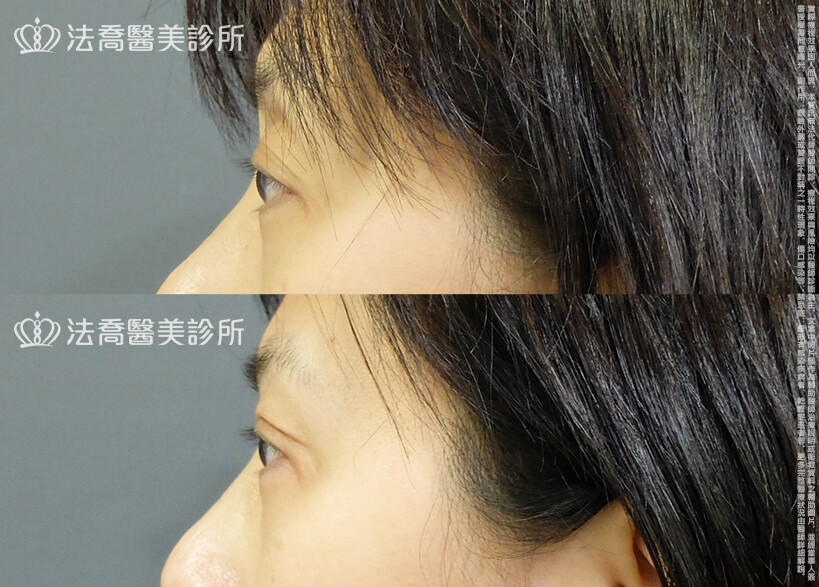 法喬醫美診所,邱浚彥,自體脂肪豐臉,割雙眼皮,眼窩補脂