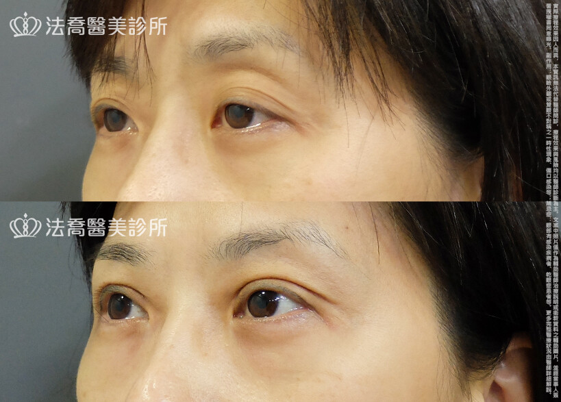 法喬醫美診所,邱浚彥,自體脂肪豐臉,割雙眼皮,眼窩補脂