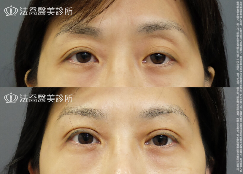 法喬醫美診所,邱浚彥,自體脂肪豐臉,割雙眼皮,眼窩補脂