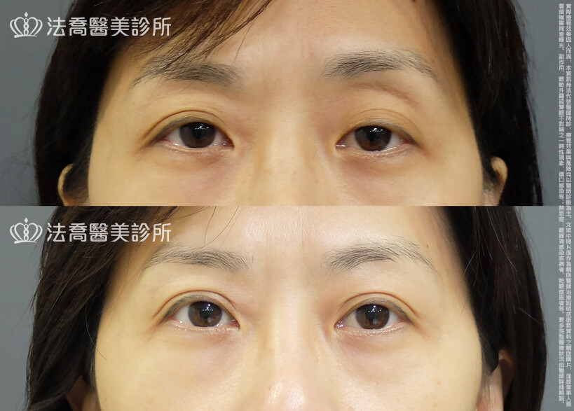 法喬醫美診所,邱浚彥,自體脂肪豐臉,割雙眼皮,眼窩補脂