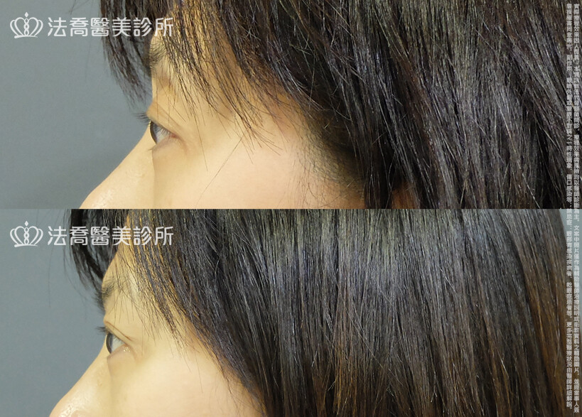 法喬醫美診所,邱浚彥,自體脂肪豐臉,割雙眼皮,眼窩補脂